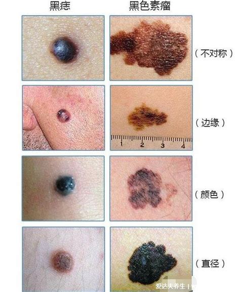 身體有痣|是痣還是瘤？黑色素瘤的類型、症狀與治療